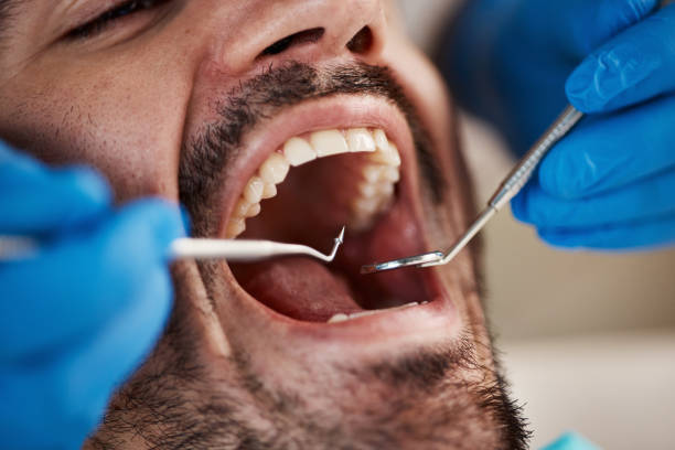 Best Emergency Wisdom Tooth Extraction in Basehor, KS